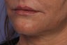 Perlane L to Lips