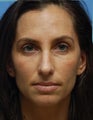 Eye Dermafillers,Cheek Dermafillers,Facial Dermafillers