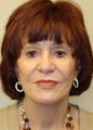 Perlane injections and mini facelift