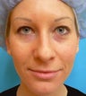 Under-Eye Filler Treatment