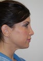Non-Surgical Nose job