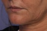 Perlane L to Lips