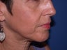 Before & After Perlane to the nasolabial folds