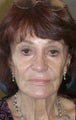 Perlane injections and mini facelift
