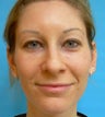 Under-Eye Filler Treatment