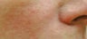 Perlane for cheeks