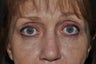 Permanent Eyeliner