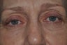 Permanent Eyeliner