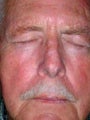 PDT for rosacea