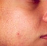 PDT for acne 
