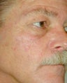 PDT for rosacea