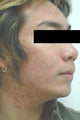 Photodynamic Therapy for Acne
