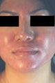 Photodynamic Therapy for Acne