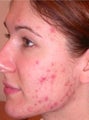 PDT for acne