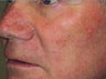 PDT treatment