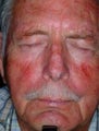 PDT for rosacea