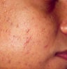 PDT for acne 