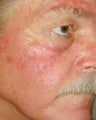 PDT for rosacea