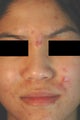 Photodynamic Therapy for Acne