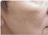photofacial
