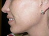 Acne scarring treatment