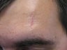 Severe, Deep Scars with Pixel