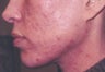 Acne scarring treatment