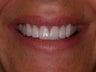 Porcelain Veneers and Porcelain Crowns