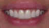 Veneer therapy