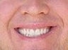 Porcelain Veneers