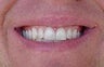 Porcelain Veneers