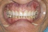 Diastema (Gap) Closure