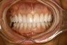 Gumline notches