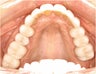 Natural All Porcelain Restorations