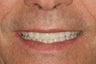 Full Smile Makeover