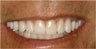 Porcelain Veneers