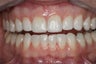 Whitening and Bonding