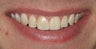 Single tooth veneer after trauma