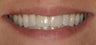 Peplacement of fractured poorly colored veneers