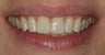 Two central incisor veneers to replace chipping discolored bonding