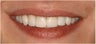 8 Veneers to a more confident smile