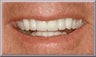 Porcelain Veneers
