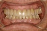 Closing black triangles between teeth