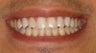 DURAthin minimal preparation porcelain veneers