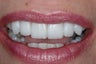 Porcelain Veneers