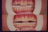 Veeners are a Great Fix For PegTeeth!