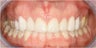 Closing Gap With Porcelain Veneers