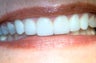 Porcelain Veneers