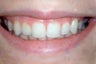 single veneer
