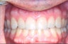 Porcelain veneers
